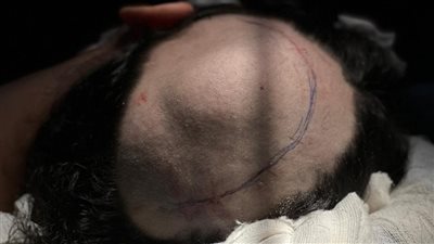 جراحة متطورة تعيد الشكل الطبيعي لجمجمة فتاة باستخدام تقنية الطباعة ثلاثية الأبعاد