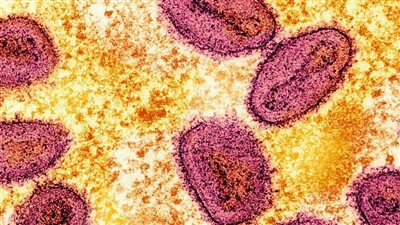 اكتشاف أول حالة إصابة بمتحول فيروس مبوكس 