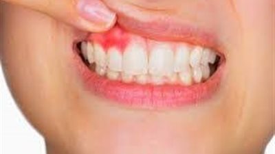 دراسة تكشف العلاقة بين أزمة غلاء المعيشة وظهور مرض قديم مرة أخرى