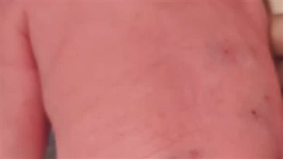 إنقاذ حياة جنين وأمه المصابة بطلق ناري 