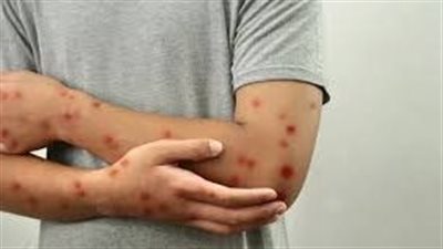 الصحة العالمية تُحذر من تزايد معدلات الإصابة بجدري القرود 