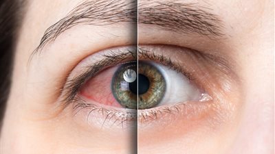 انتبه.. أعراض ترافق جفاف العين قد تنذرك بمشكلة صحية خطيرة
