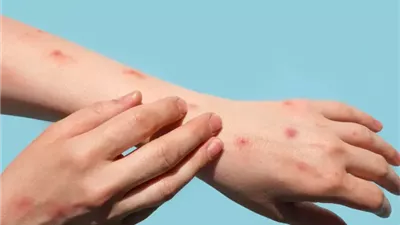 رصد أول حالة بالسلالة الأخطر من جدري القرود في بريطانيا