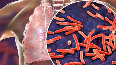 تسجيل مستوى قياسي لحالات الإصابة بالسل خلال 28 عامًا