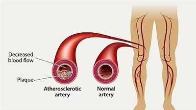 علامات تحذر من ارتفاع معدلات الكوليسترول في الدم 