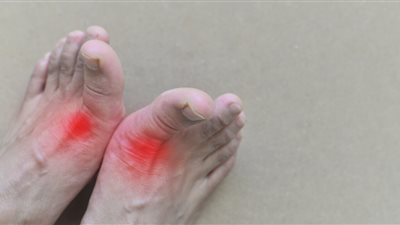 دراسة تكشف السبب الرئيسي للإصابة بالنقرس