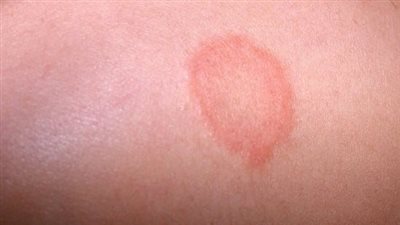 باحثون يتوصلون لعلاج مناعي جديد لسرطان الجلد يحقق نتائج باهرة (تفاصيل)