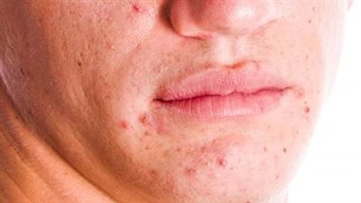 التخلص من حب الشباب| نصائح طبية وأهم العلاجات الفعّالة