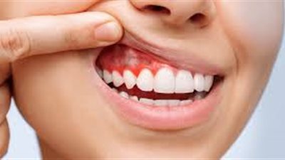 دراسة:أمراض اللثة تزيد خطر الإصابة بأمراض القلب