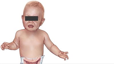 «داء اليهود».. 80% من مرضى «جوشيه» بمصر نتيجة زواج الأقارب