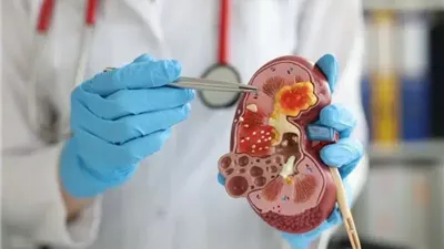 دراسة تكشف العلاقة بين النحاس وأكثر أنواع سرطان الكلى انتشارًا