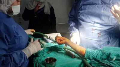 نجاح أول جراحة عظام بمستشفى زاوية الناعورة بالمنوفية بعد توقف عام كامل 