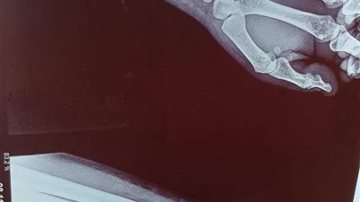 علاج كسر مفتت في عظمة الكعبرة لأول مرة بمستشفى أشمون العام