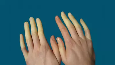 اختبار بسيط يكشف عن مرض 