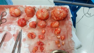 مستشفى ميت غمر تنجح فى استئصال 20 ورم ليفي من رحم فتاة