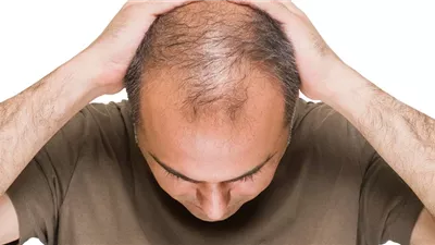 هل ارتداء القبعة باستمرار يسبب تساقط الشعر؟