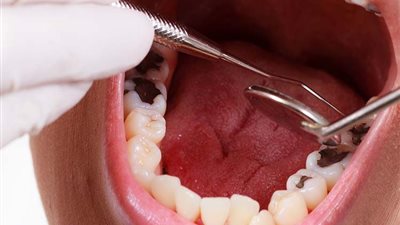 احذر.. أضرار يسببها تسوس الأسنان للجسم