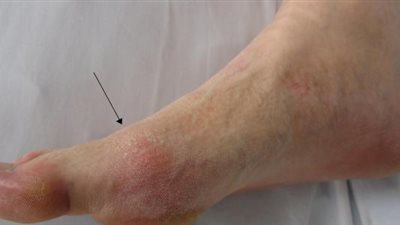 طبيب يكشف عن نظام غذائي يقلل من خطر الإصابة بالنقرس