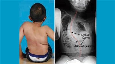 الطفل الزجاجى