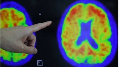 الذكاء الاصطناعي يتنبأ بالزهايمر عبر صوتك قبل حدوثه بـ 6 سنوات