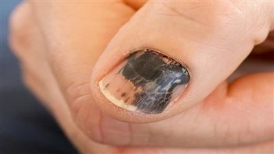 أبرز أعراض الإصابة بسرطان الأظافر وطرق علاجه