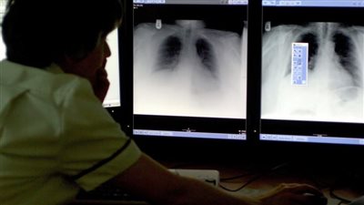 تطوير اختبار جديد لاكتشاف أعراض سرطان الرئة المبكرة