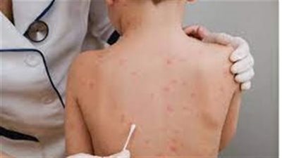 الصحة الكينية: تسجيل 5 حالات إصابة جديدة بجدري القردة