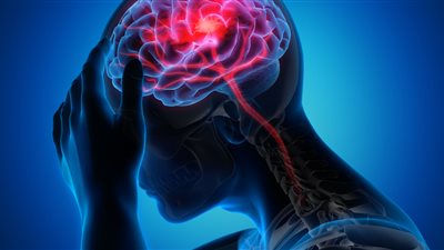 طبيب يحدد طريقة بسيطة لكشف الإصابة بجلطة دماغية