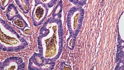 ارتفاع حالات سرطان الأمعاء بين الشباب .. ما علاقة الأطعمة المعالجة؟
