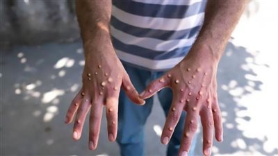 «جدرى القرود» يُنذر بجائحة جديدة