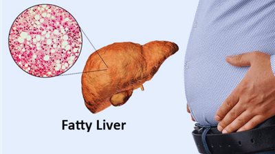 5 عصائر طبيعة لعلاج الكبد الدهني