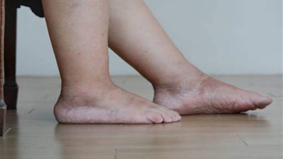 انتبه.. أبرز أسباب احتباس السوائل في الجسم