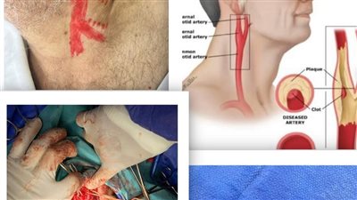 مستشفى السنبلاوين تنجح فى إنقاذ حياة مريض يعانى من جلطة بالمخ 