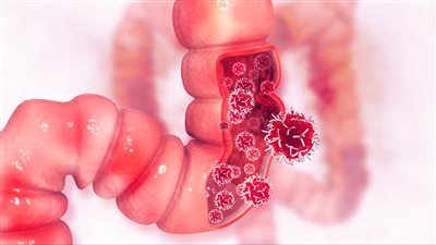 دراسة تكشف سبب انتشار سرطان القولون بين الشباب