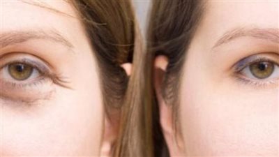 3 خلطات طبيعية للتخلص من تجاعيد العينين بخطوات بسيطة