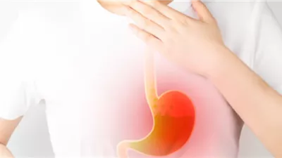 طبيب يكشف أضرار الإرتجاع الحمضي