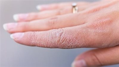 أسباب جفاف اليدين في الشتاء.. نصائح لا غنى عنها 