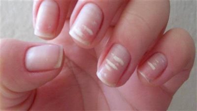 لا تتجاهلها.. تغييرات شكل الأظافر تشير إلى الإصابة بعدة أمراض 