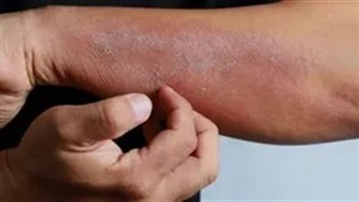 VEXAS..  ما هو مرض فيكساس وأكثر الفئات عرضة للخطر بعد ظهوره في مصر 