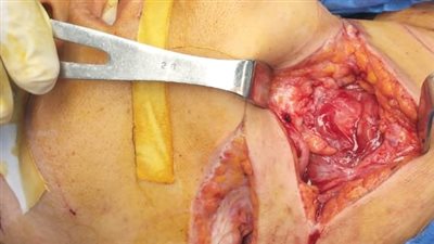 إنقاذ سيدة مصابة بجروح قطعية متعددة وطعنة عميقة بالرقبة بمستشفى سوهاج الجامعي 