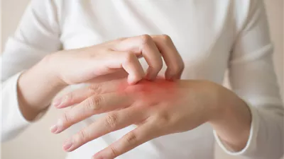 هل التوتر يؤدي إلى الإصابة بحساسية الجلد؟.. دراسة تجيب