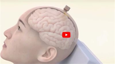 علماء صينيون يتوصلون لواجهة دماغية قابلة للزرع (شاهد)