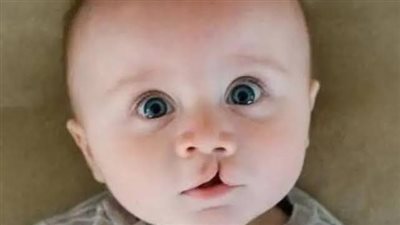 أنواع الشفة الأرنبية وشق الحَلق عند الأطفال.. الموعد المناسب للجراحة 