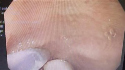 مستشفى العامرية بالإسكندرية ينقذ رضيعا ابتلع أنبوبة بلاستيك