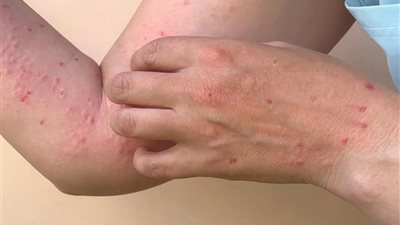 في أقل من أسبوعين.. اكتشاف ثالث حالة إصابة بجدري القرودة ببريطانيا