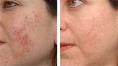 طرق طبيعية للتخلص من آثار حب الشباب وتحسين مظهر البشرة