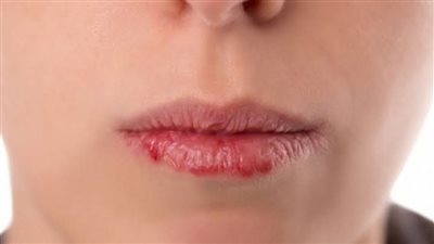 وصفات طبيعية لعلاج تشقق الشفاه ومنحها نعومة ولمعان