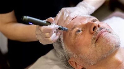 كل ماتريدين معرفته عن الوخز بالإبر الدقيقة لعلاج مشاكل البشرة 