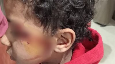 قطع وشه.. تفاصيل الاعتداء على طالب بآلة حادة داخل مدرسة بسوهاج