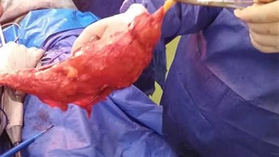 استئصال جذري لورم سرطاني بالمثانة لمريض في الإسكندرية 